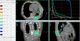 Malignant pleural mesothelioma (mpm) is a rare tumour that has become a world health issue due to its poor prognosis and its increasing incidence, largely due to prior asbestos exposure. C33dvwtii1xnhm
