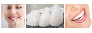 DENTAL VENEERS