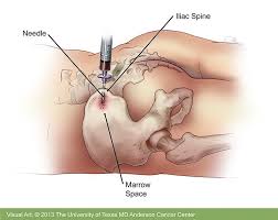 Medical illustration of bone marrow aspiration from the hip for leukemia evaluation