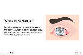 Image result for Keratitis