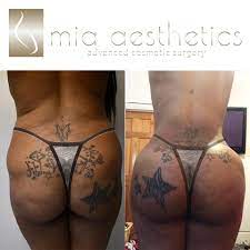 • plastic surgeon at mia miami • for all inquires & questions dm @mia_aesthetics or @mia_aesthetics_miami. Mia Aesthetics Dr Palladino Does It Again Happypatient Palladinodollmia42418 See More On Our Instagram Stories Lipo 360 Bbl Procedure Surgery Performed By Themagicsurgeon Height