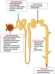 Image result for Isolated Proteinuria