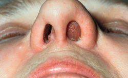 Eine chronische entzündung der nasenschleimhaut; Rhinosinusitis Viel Mehr Als Ein Starker Schnupfen Pz Pharmazeutische Zeitung