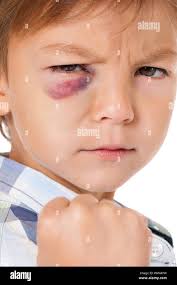 Beat up eye hi-res stock photography and images