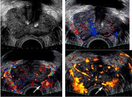 Learn more about prostate cancer basics at discovery health. Enhanced Transrectal Ultrasound Modalities In The Diagnosis Of Prostate Cancer Urology