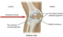 Image result for what is valgus and varus stress