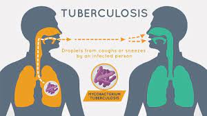 This widespread form of tb disease, called disseminated tb or miliary tb, occurs most commonly in the very young, the very old and those with hiv infections. Tuberculosis Risk Factors Causes And Prevention Everydayhealth