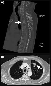 Lung cancer is often divided into two types: A Fatal Case Of Spinal Tuberculosis Mistaken For Metastatic Lung Cancer Recalling Ancient Pott S Disease Abstract Europe Pmc