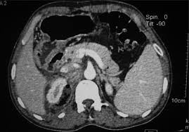 Image result for Perinephric Abscess