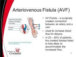 14,988 likes · 11 talking about this. Resultado De Imagen De Arteriovenous Fistula Hemodialysis Imagenes