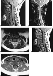 White matter diseases are a group of conditions that predominantly or significantly affect the white matter of the brain. 4 Transverse Myelitis Radiology Key
