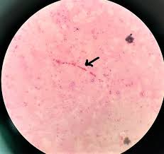 Image result for chancroid