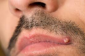 This should make the bulge to let the ingrown hairs get out. How To Get Rid Of Ingrown Hair And Avoid Getting It