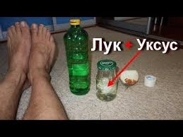 как избавиться от шипицы на ноге в домашних условиях Shipica Podoshvennaya Mozol Ili Borodavka So Sterzhnem Uksus I Luk Proshaj Borodavki I Mozoli Youtube V 2020 G Uksus Zdorove Luk
