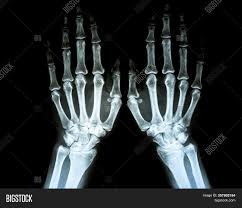 For more information and past images of the month, go to. Film X Ray Rheumatoid Image Photo Free Trial Bigstock