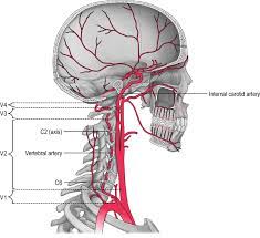 How is carotid artery disease treated? 2 The Course Of The Vertebral And Internal Carotid Arteries Through The Download Scientific Diagram