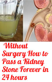 Without Surgery How To Pass A Kidney Stone Forever In 24 Hours Kidney Stones Kidney Stones Remedy Kidney