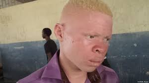 Al·bi·nos an individual with albinism. Mozambican Albinos Life In Fear Africa Dw 18 11 2015