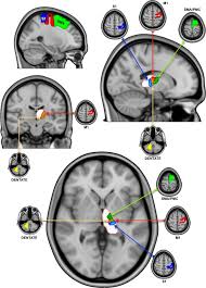 Image result for Thalamic Stimulation