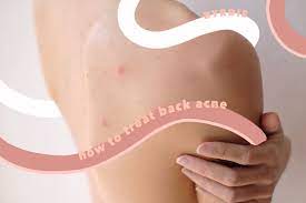 Wash your back with warm water and pat dry with a towel. How To Get Rid Of Back Acne And Back Acne Scars