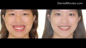 Braces can be another way to fix a gummy smile, depending on the cause of your gummy smile. Gummy Smile Treatment Youtube