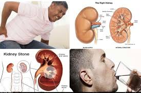 Pain While Passing Urine Could Be A Sign Of Kidney Stones The New Times Rwanda