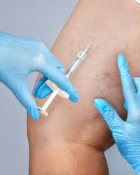 Sotradecol injection is available in. Vein Injection Sclerotherapy Meridian Cosmetic