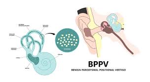 Image result for Canalith Repositioning Procedure