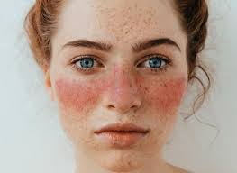 Scientists finally discover the cause of lupus