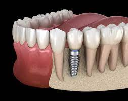 Maybe you would like to learn more about one of these? Dental Implants Muscaro Martini Dentistry Tampa Fl