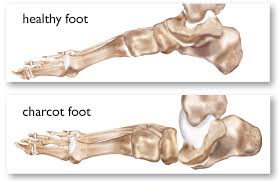 Precisely 187 years after his birth, professor charcot, the preeminent french father of neurology remains vivid to perception and treasured to the mind. Charcot Foot Capital Foot And Ankle