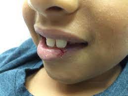 Harlow falls and get a super scary busted lip. Lip Lacerations Part Ii Closing The Gap