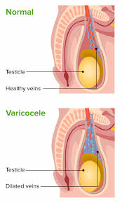 Image result for Varicocele