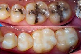 I finished it on wednesday evening. How To Get Rid Of Cavities The Easy Way Doctor Sutera Explains