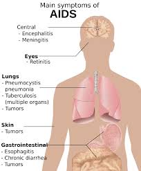 Pin On Hiv Aids Life
