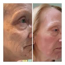 Bill Brandon BSN RN CWCN