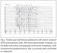 Scielo Brasil Juvenile Myoclonic Epilepsy Juvenile Myoclonic Epilepsy