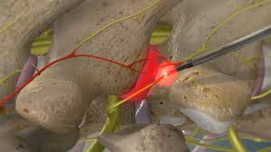 Image result for Radiofrequency Surgery