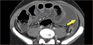 There&#x27;s no history of syncope or. The Radiology Assistant Peritoneal Pathology