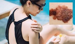 Other features to look out for. Skin Cancer Symptoms What Does Skin Cancer Look Like Five Signs You Shouldn T Ignore Newsstreet One