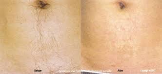 Based on the size of the area to be treated determines the cost of the laser hair removal treatment. Laser Hair Removal Silverdale And Gig Harbor Wa Eric Rasmussen Md Peninsulaskincare Com