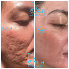 Laser scar removal before and after. Acne Scar Laser Treatment Removal London Dr H Consult