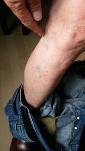 3737 west chapman avenue, orange, ca 92868, united states. Holidaymakers Attacked By Bedbugs Left Mentally Scarred After Infestation At Four Star Hotel Ruins 2 000 Trip Mirror Online