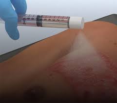 Osu Hospital Introducing Spray On Skin Treatment For Burn Victims Wcbe 90 5 Fm