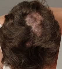 This usually consists of thinning of the hair that is not necessarily permanent. Alopecias In Lupus Erythematosus Lupus Science Medicine