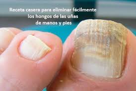 Hongos En Las Uñas De Las Manos Como Eliminarlos Como Eliminar Los Hongos De Las Manos Y Los Pies De Manera Rapida En 2020 Remedio Hongos Pies Remedio Para Hongos Tratamiento Para Hongos En Las Unas