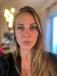 Upper blepharoplasty recovery at 6 weeks