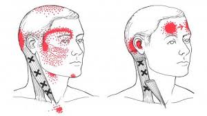 pain in face and jaw caused by trigger points