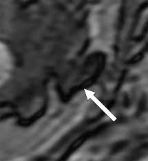 Image result for Spinal Dysraphism