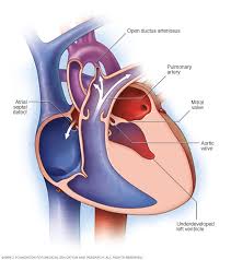 Hypoplastic left heart syndrome - Symptoms and causes - Mayo Clinic